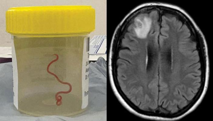 Vid O Vivant Et Tortillant Un Ver De Cm Retir Du Cerveau D Une