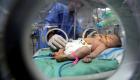 أطباء غزة في تحدٍ أمام توأمتين ملتصقتين