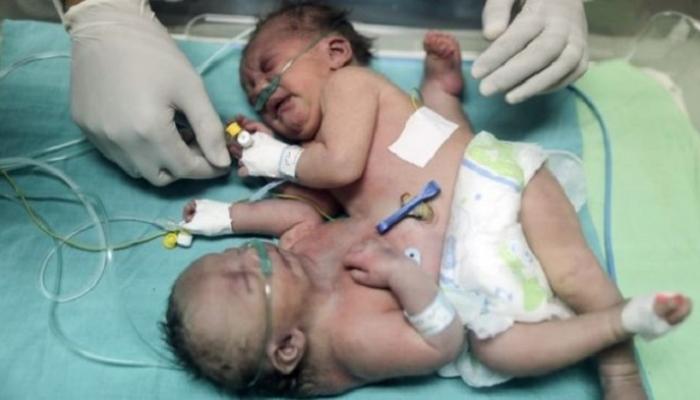 حصار غزة يعرض حياة توأم ملتصق للخطر