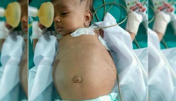 العثور على جنين داخل معدة طفل عمره 3 شهور