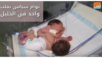 توأم ملتصق من الصدر والبطن وبقلب واحد في الخليل