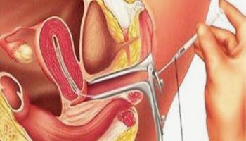 علماء يطورون "الرحم الاصطناعي" لبقاء الأطفال المبتسرين أحياء