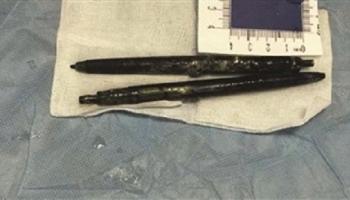 طبيب يزيل قلمين من أمعاء رجل