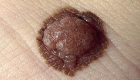نصائح لاكتشاف سرطان الجلد في وقت مبكر