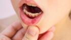 قرحة الفم.. 8 نصائح لتخفيف الألم والتعجيل بالشفاء