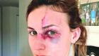 برازيلية على انستقرام: خطيبي ضربني بسبب صورة مكشوفة الرقبة