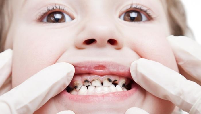 الوقاية من تسوس الأسنان اللبنية - صورة أرشيفية