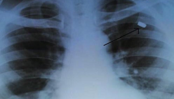 صورة الأشعة تبين موضع الرصاصة قبل استخراجها من صدر الرجل