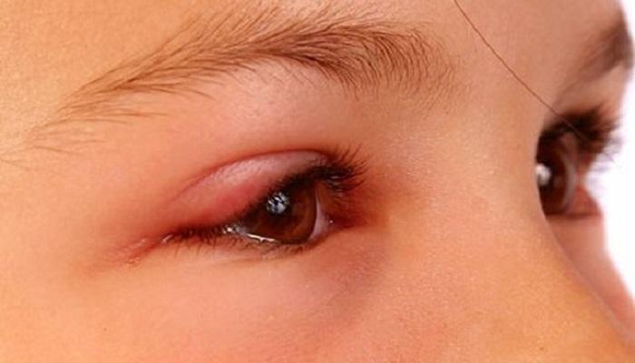 الوذمة الوعائية مرض وراثي نادر