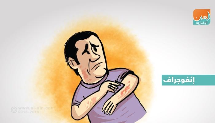 6 أسباب وراء الإصابة بالإكزيما