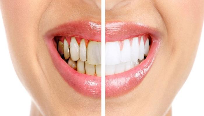 طريق الوقاية من تسوس الأسنان.. ووصفات طبيعية للعلاج