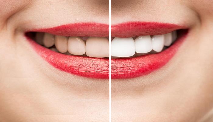 4 خطوات للحصول على أسنان بيضاء بشكل دائم