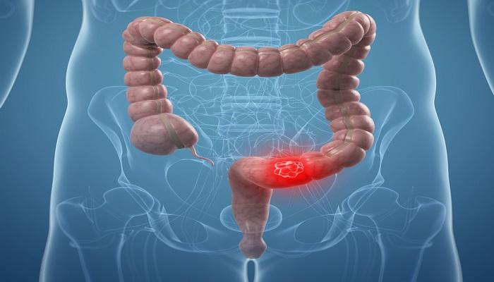 النظام الغذائي المتوازن يحمي من سرطان الأمعاء