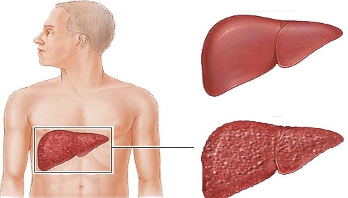 التهاب الكبد الوبائي سي وأسبابه وأعراضه وطرق انتقاله