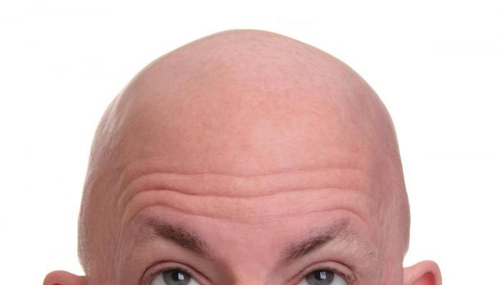 علاج فعال لمكافحة الصلع