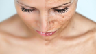 8 طرق طبيعية للتخلص من بقع الجلد الداكنة