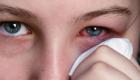 6 نصائح تجنب مرضى حساسية العيون مخاطر العواصف الترابية
