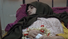 الإمارات تتكفل بعلاج طفلة يمنية تعرضت لشظايا حوثية