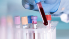 اختبار دم جديد يحدد العلاج المناسب لسرطان الرئة