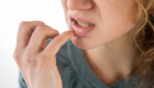 نصائح لتجنب الإصابة بقرحة الفم
