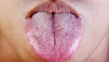 الطبقة البيضاء القوية على اللسان علامة على إصابة فطرية