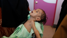 16 مليون طفل يعانون من سوء التغذية في 4 دول عربية