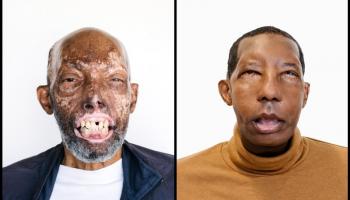 روبرت تشيلسيا أول أمريكي من أصل أفريقي يجري عملية زراعة وجه