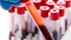 "تنظيف الدماء".. تقنية جديدة لمكافحة السرطان بالمغناطيس
