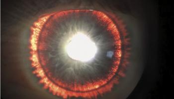 خضع الرجل لعلاج بالليزر لتخفيف السوائل في قنوات تصريف العين