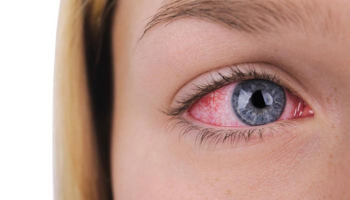 العيون الحمراء سبب احمرار العيون: