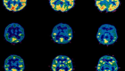 تصوير الدماغ يكشف أمراض الأطفال العقلية مبكرا
