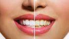 لون اللثة يكشف صحة الأسنان