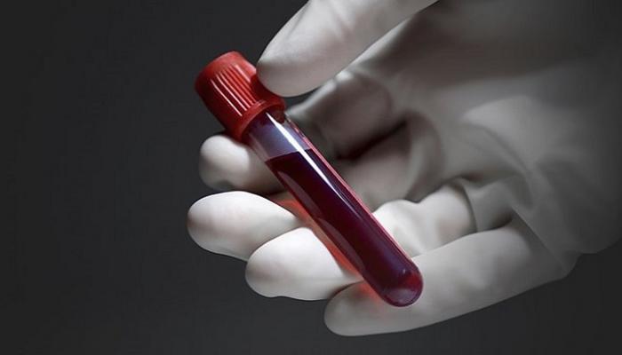 تحليل دم يكشف المراحل المبكرة من تراكم الدهون في الكبد