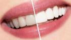أسباب اصفرار الأسنان وكيفية علاجه وتنظيف الأسنان طبيعيا