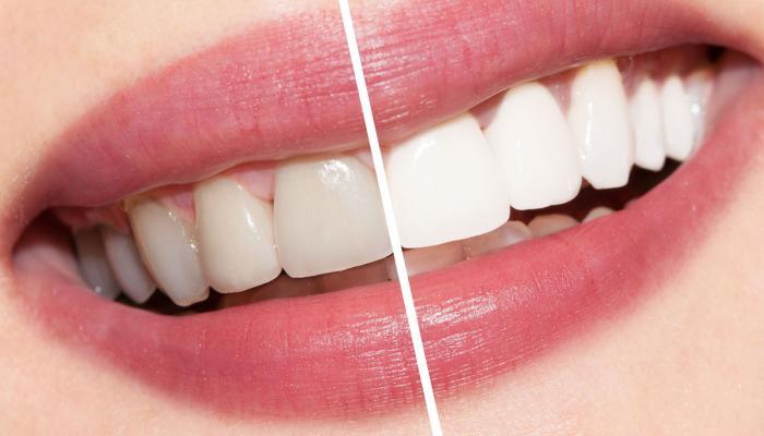 طرق إزالة اصفرار الأسنان