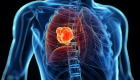 دراسة: العلاج المناعي يزيد أمل الحياة لمرضى سرطان الرئة