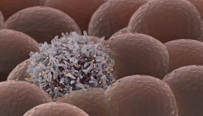 خلية سرطانية