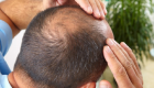 "إيقاظ البصيلات النائمة".. تقنية جديدة لعلاج تساقط الشعر