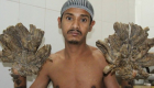 "رجل الشجرة" يتمنى بتر يده.. لا أتحمل الألم