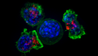 "كوكساكي".. فيروس يدمّر خلايا سرطان المثانة