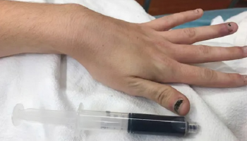 تحول لون دماء فتاة أمريكية للأزرق