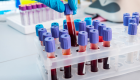 اختبار يكشف 20 نوعا من السرطان بقطرة دم