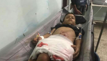 طفل يمني أصيب في قصف سابق لمليشيا الحوثي- أرشيفية