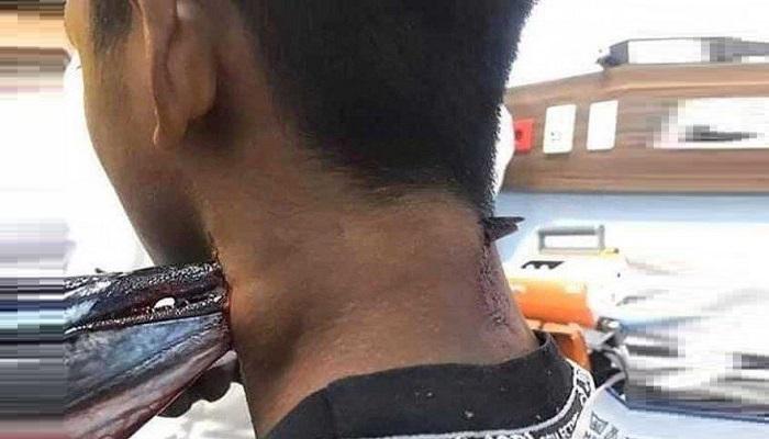 سمكة إبرة تخترق عنق إندونيسي - أرشيفية