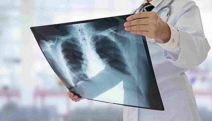 المتعافون من كورونا يعانون من التهاب في الرئة بعد مرور 3 أشهر على شفائهم