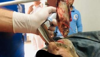 السمكة بعد استخراجها من فم الصياد