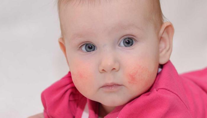 حساسية الحليب عند الرضع الأعراض والعلاج
