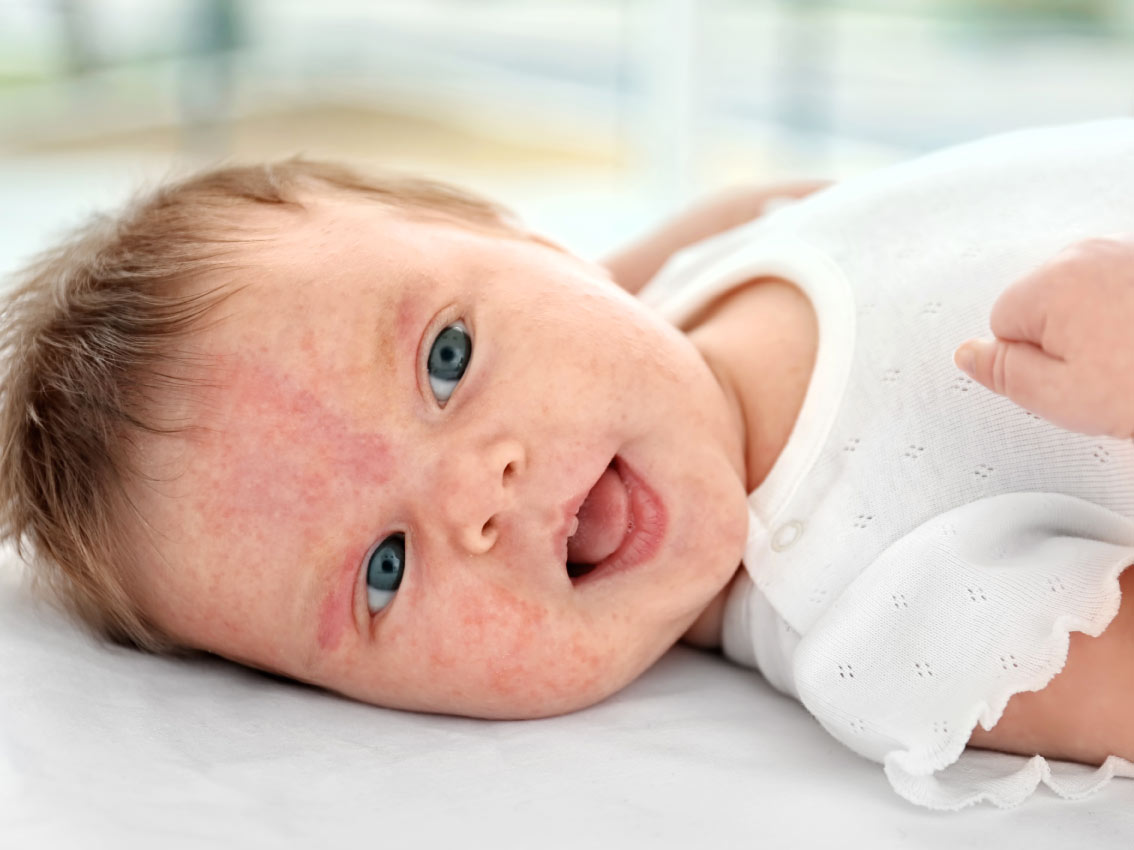 حافز قسم الامن حزام  حساسية الحليب عند الرضع.. الأعراض والعلاج