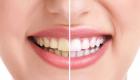 كيفية التخلص من البقع البنية على الأسنان بوصفات طبيعية؟