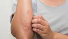 التهاب الجلد التماسي.. هاني الناظر يكشف الأسباب والعلاج